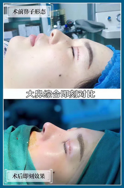 上海鼻整形医生推荐