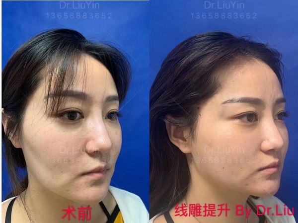 刘垠整形