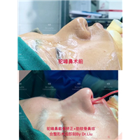 昆明鼻整形专家