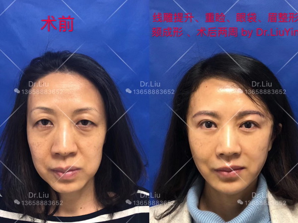 刘垠整形