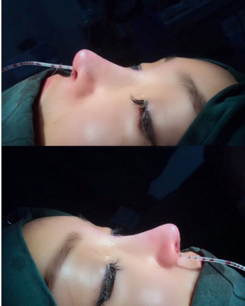 云南鼻整形专家