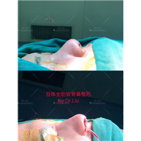 昆明鼻整形专家