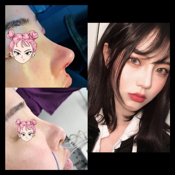 云南鼻整形专家