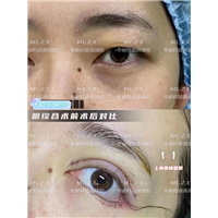 上海眼综合整形