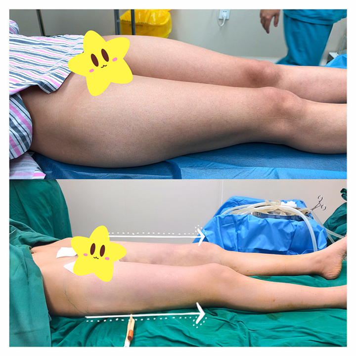 安禾美阁大腿吸脂效果