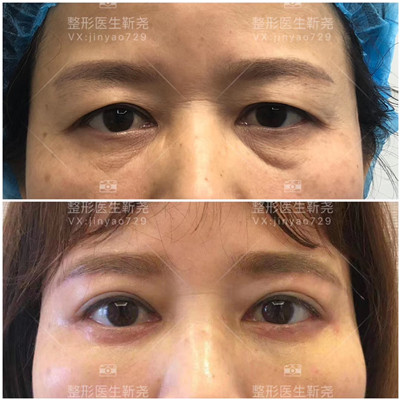 西安肋骨隆鼻整形专家 