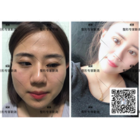 自体脂肪填充整形