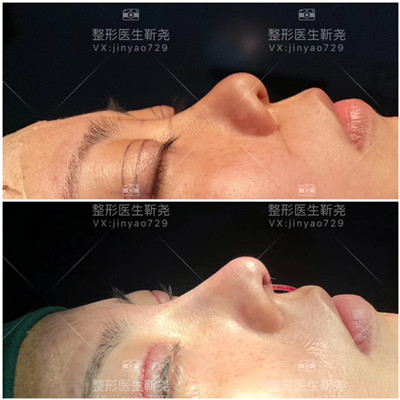 西安专家鼻整形专家 