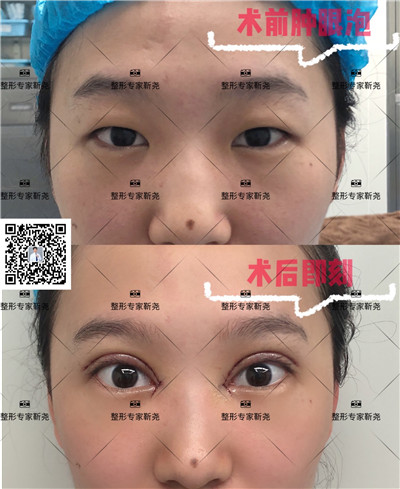 西安眼部修复整形专家 