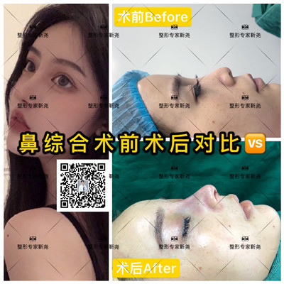 西安鼻综合整形专家 