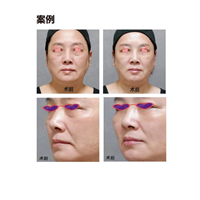 玻尿酸吸收代谢会加速衰老吗？