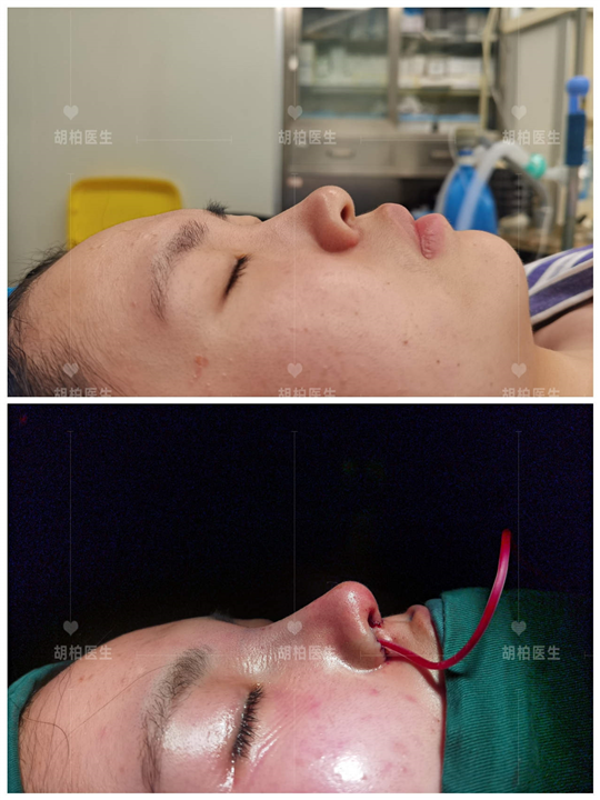 胡柏肋骨鼻整形