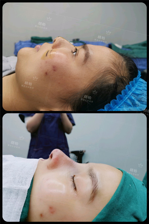 浙江鼻整形专家胡柏说鼻整形 