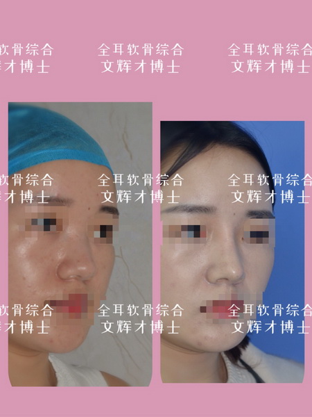 南昌鼻整形修复专家 