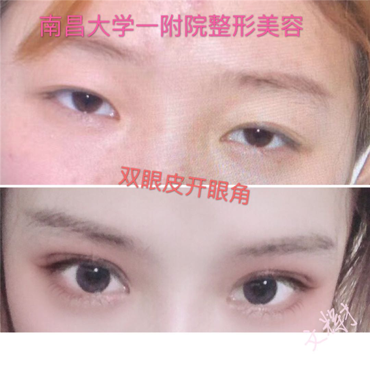 南昌一附院文辉才双眼皮开眼角 
