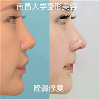 南昌大学整形美容科隆鼻修复
