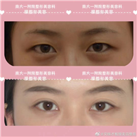 南昌文辉才医生眼部整形