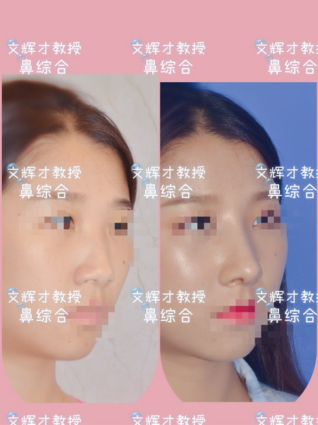 南昌鼻整形修复 