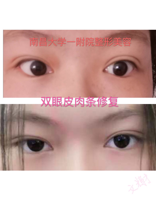 南昌一附院文辉才双眼皮修复 