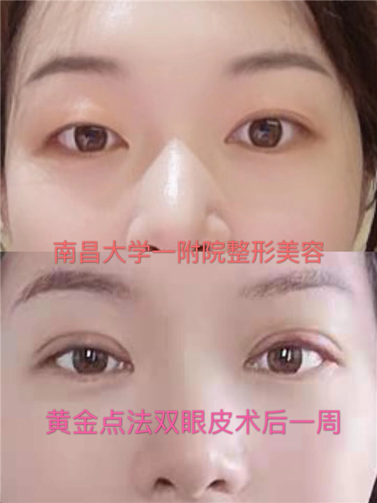 南昌文辉才医生双眼皮修复案例 