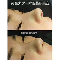 南昌肋软骨鼻综合整形