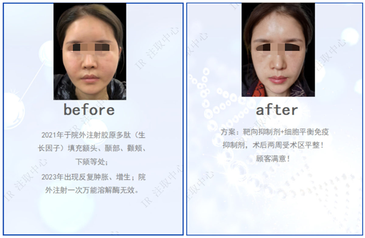 上海生长因子取出费用多少