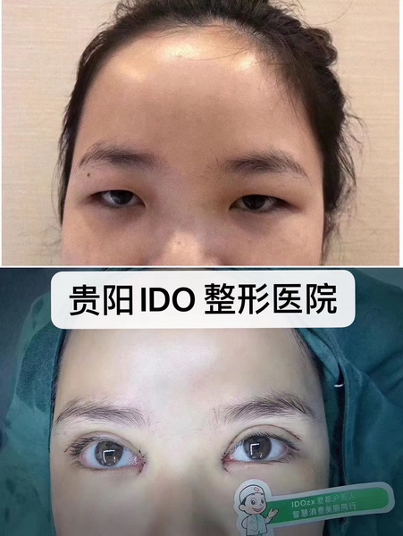 贵阳ido整形