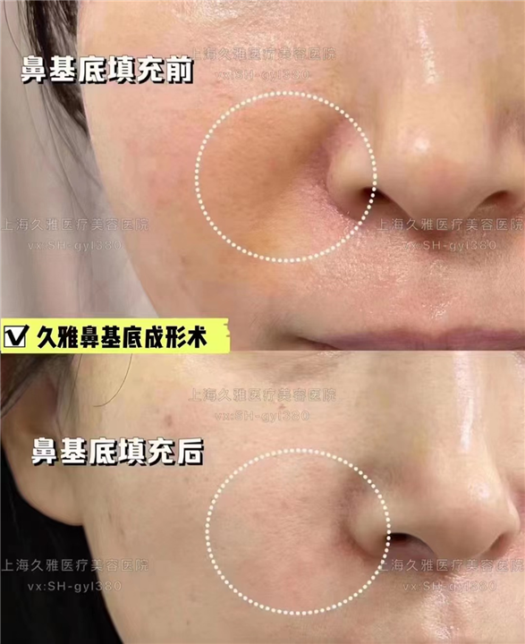 上海久雅整形鼻基底填充