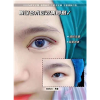 上海久雅整形眼综合术后效果