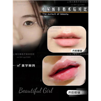 上海久雅玻尿酸丰唇