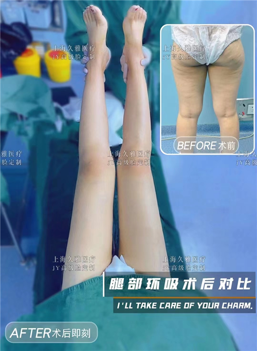 上海久雅医疗美容腿部吸脂
