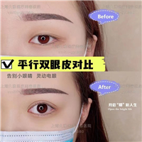上海久雅医疗美容医院双眼皮