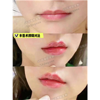 上海久雅整形丰唇术