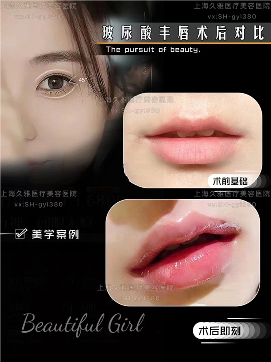 上海久雅玻尿酸丰唇