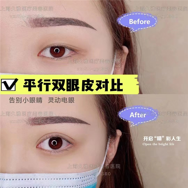 上海久雅医疗美容医院双眼皮