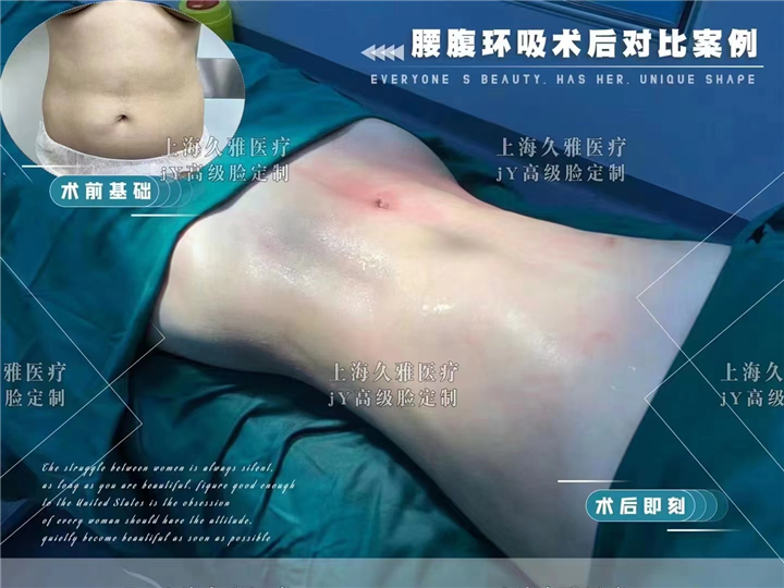 上海久雅医疗腰腹环吸