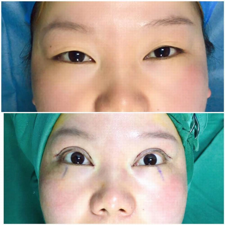 贵阳眼综合整形医生