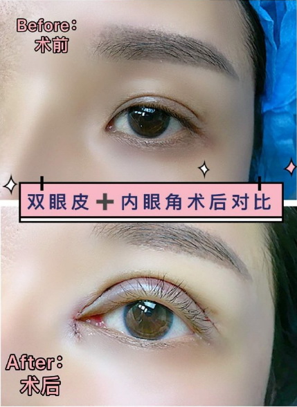 重庆眼整形修复 