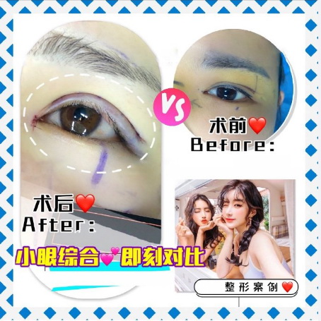 重庆眼整形修复 
