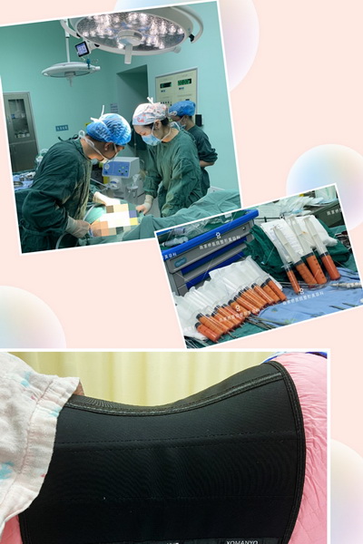 重庆自体脂肪填充 