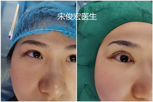 重庆双眼皮修复整形 