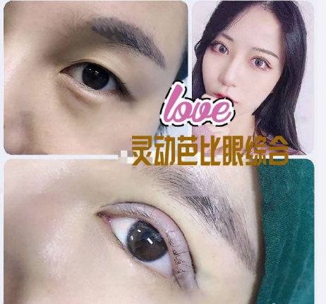 重庆双眼皮修复整形 
