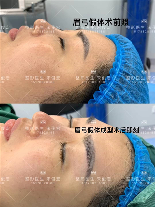 宋俊宏鼻整形修复