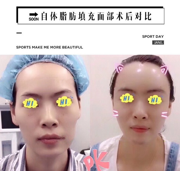 重庆脸部脂肪填充 