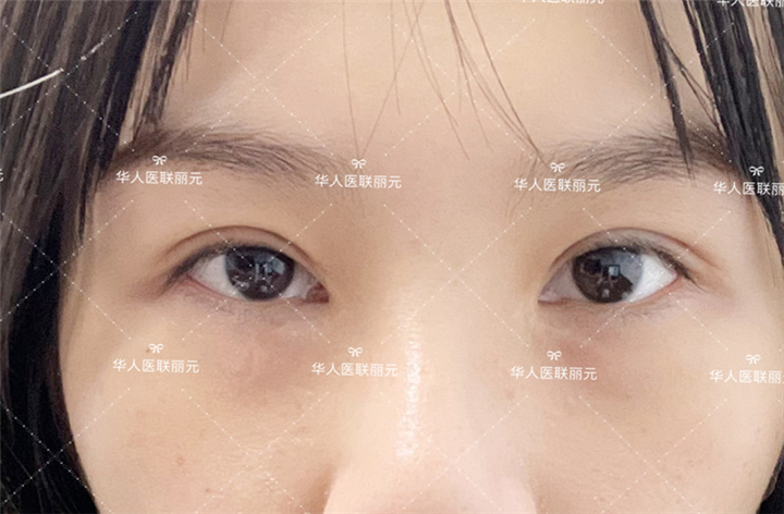 成都高亮医生双眼皮怎么样