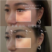 印第安纹怎么去除效果好