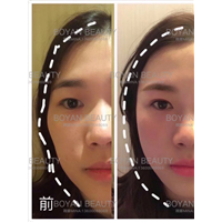 剥离咬合关节 