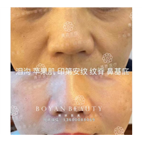北京印第安纹剥离