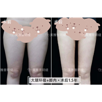 大腿环吸+膝内
