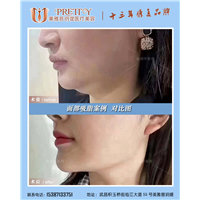 面部吸脂案例
